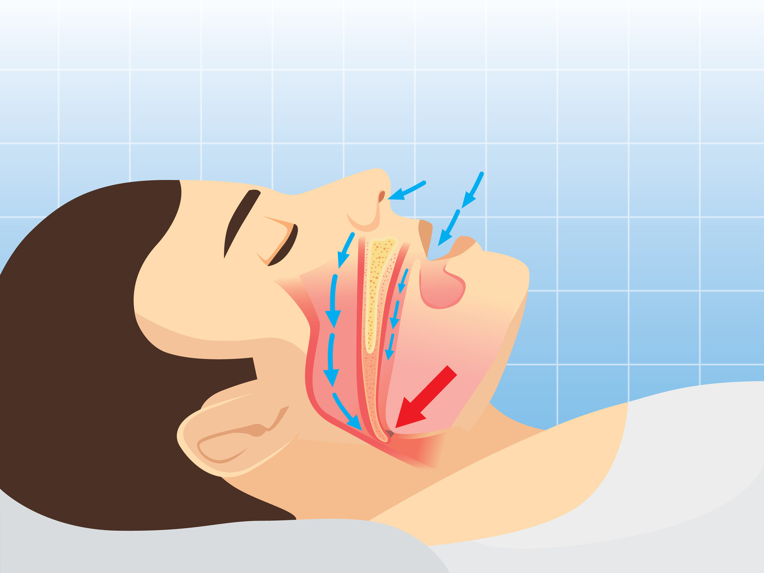 Eine Schnarchtherapie ist wichtig, denn Schnarchen kann die Gesundheit gefährden