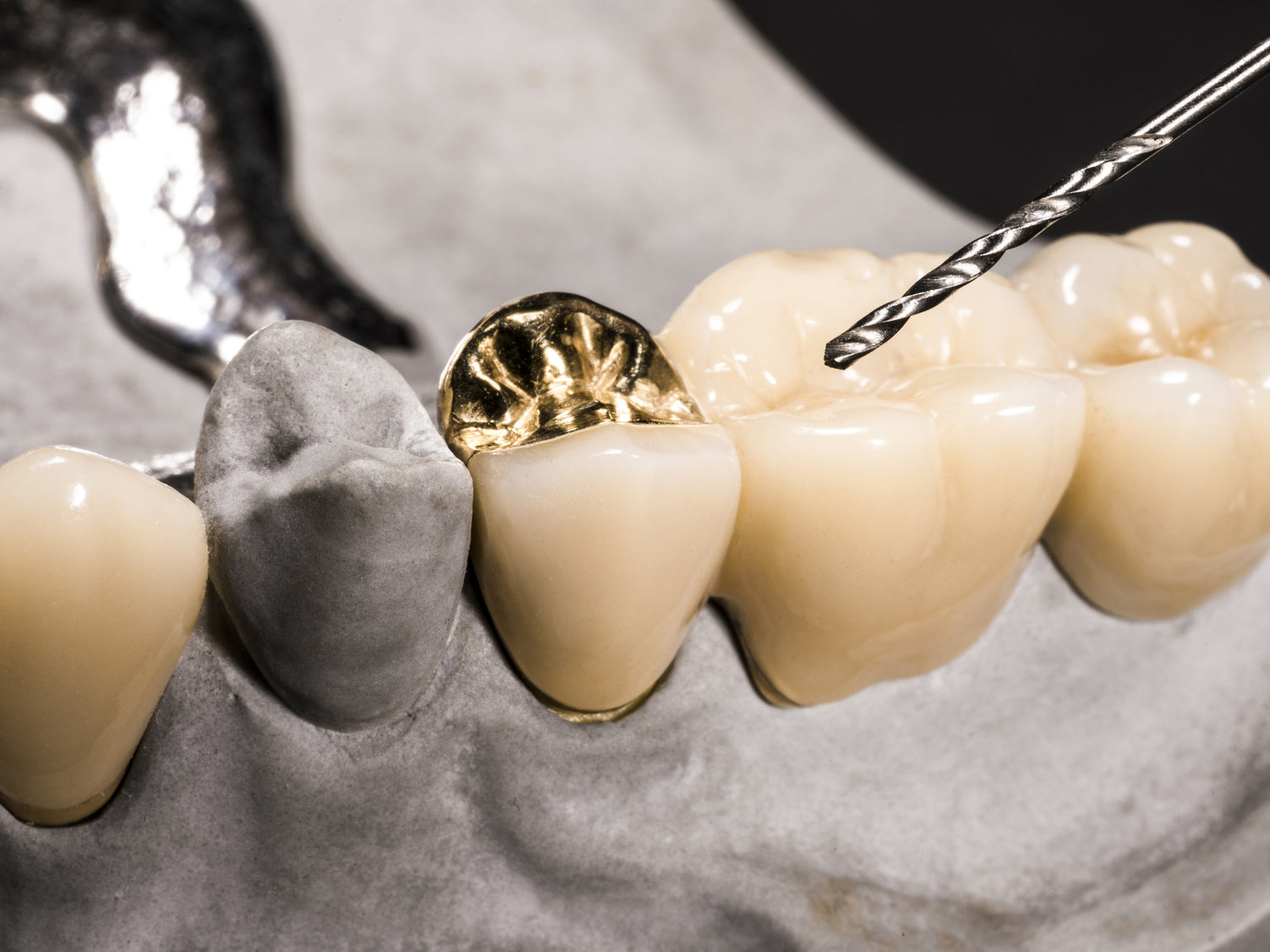 Zahnkronen aus Gold sind sehr stabil und langlebig