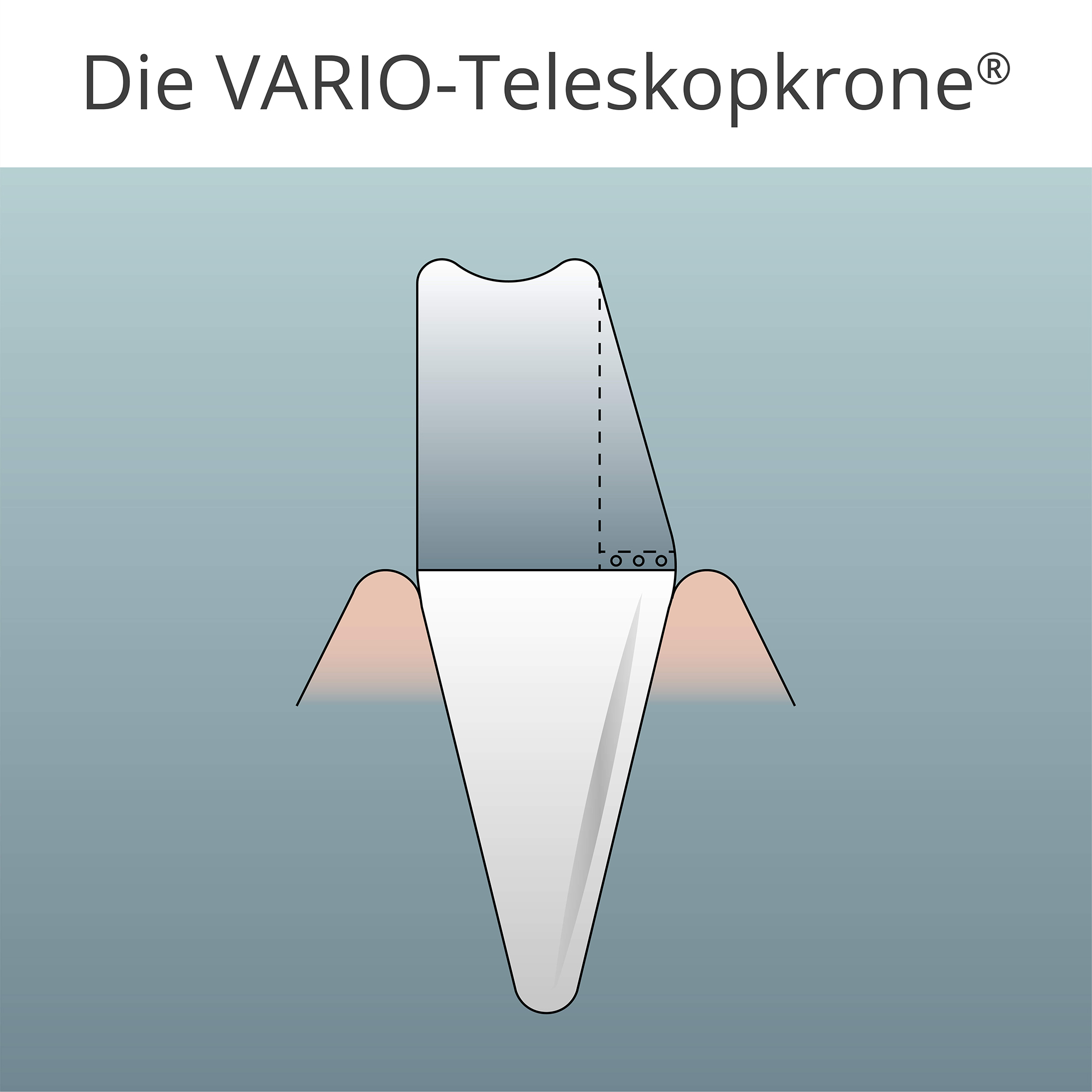 Durch eine spezielle Frästechnik bietet die VARIO®-Teleskopkrone optimalen Halt 