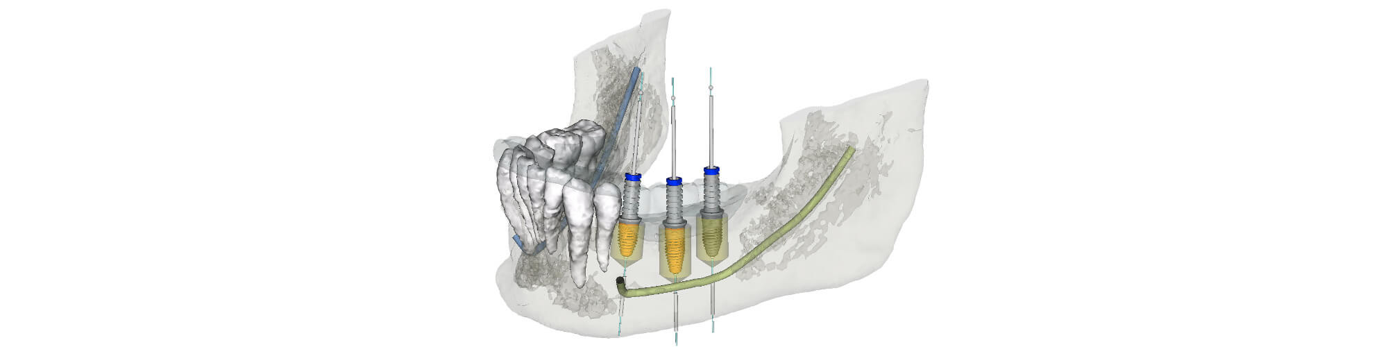 3D Implantatplanung in München