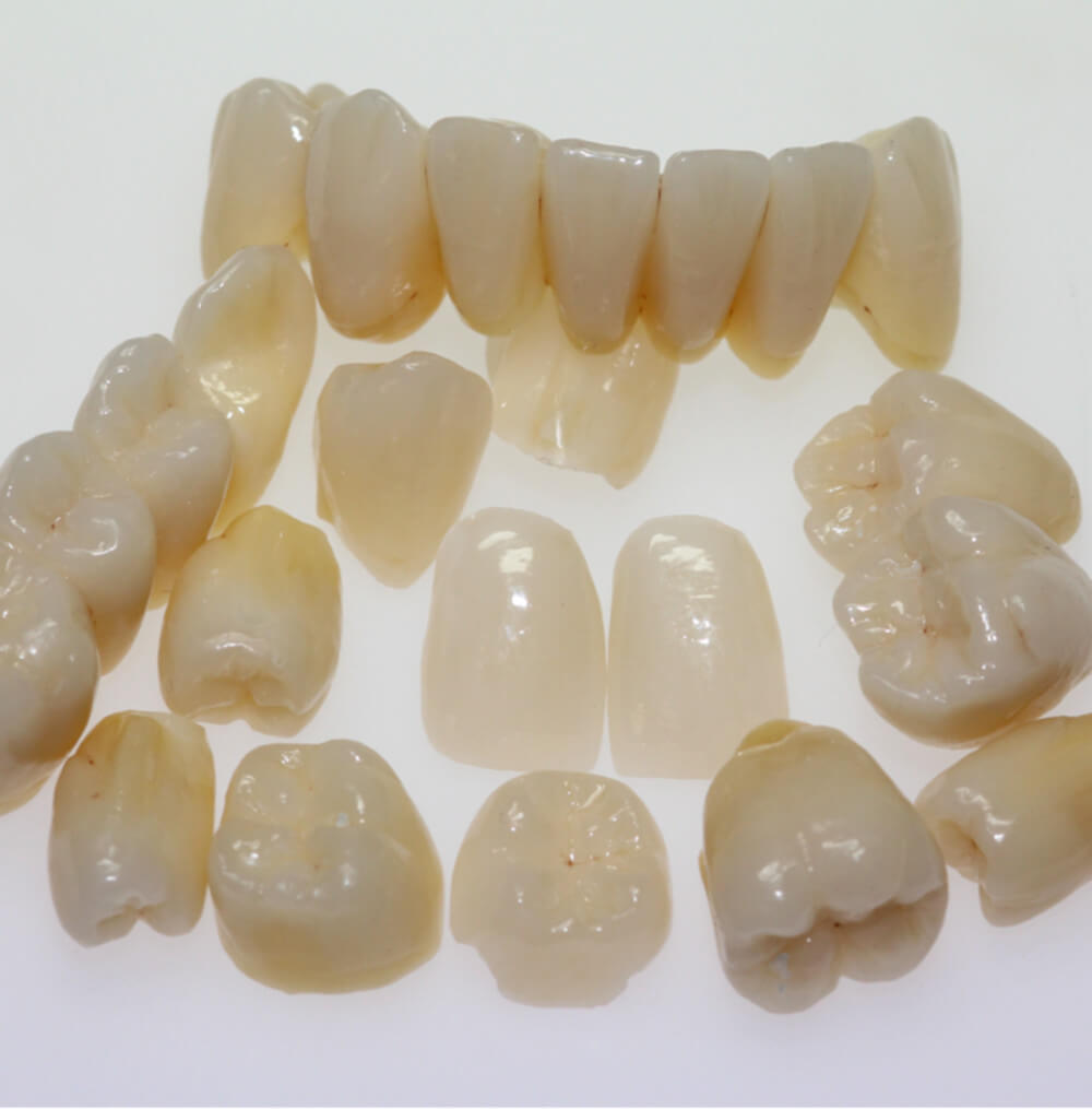 Veneers, Kronen und Teilkronen aus Vollkeramik und Zirkoniumoxid Veneers, Kronen und Teilkronen aus Vollkeramik und Zirkoniumoxid