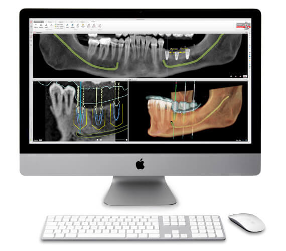 Digitale Prozesse bieten große Vorteile in der Implantologie: Detailreiche DVT-Aufnahmen erlauben die präzise und sichere 3D-Planung von Implantaten am Computer