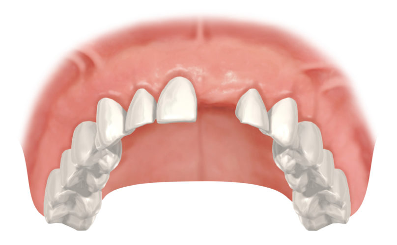 Vorteil beim Verschluss einer Einzelzahnlücke: Bei einem Implantat bleiben die Nachbarzähne unversehrt im Gegensatz zur Versorgung mit einer Brücke