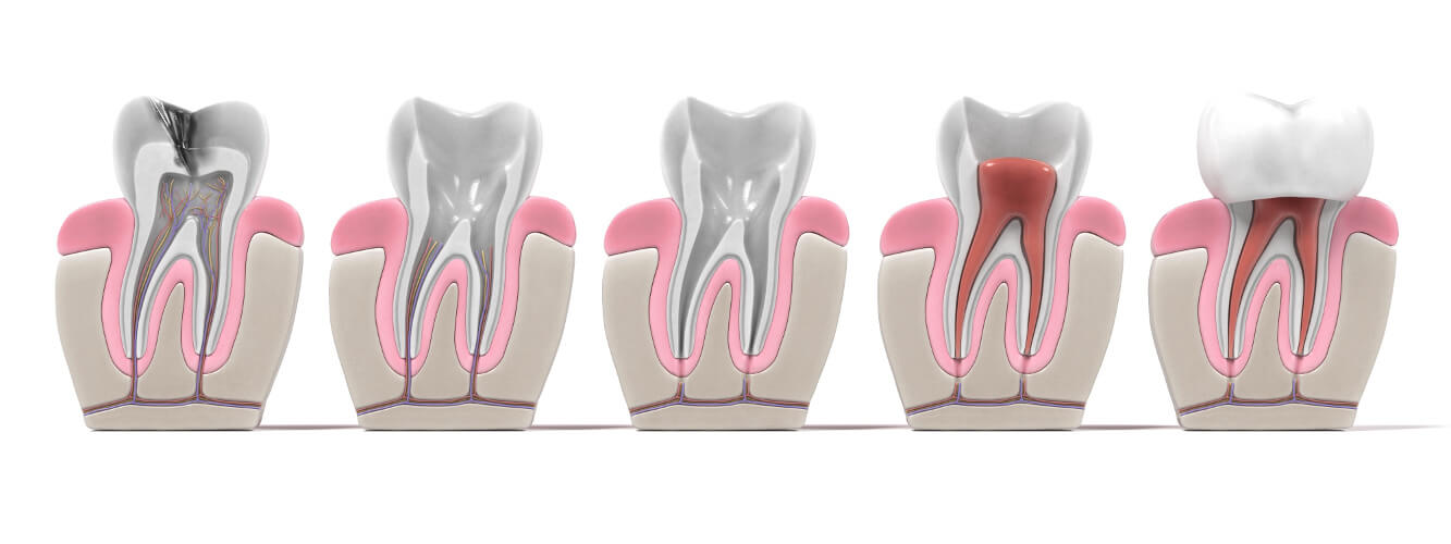 Endodontie in München bei MunichDent