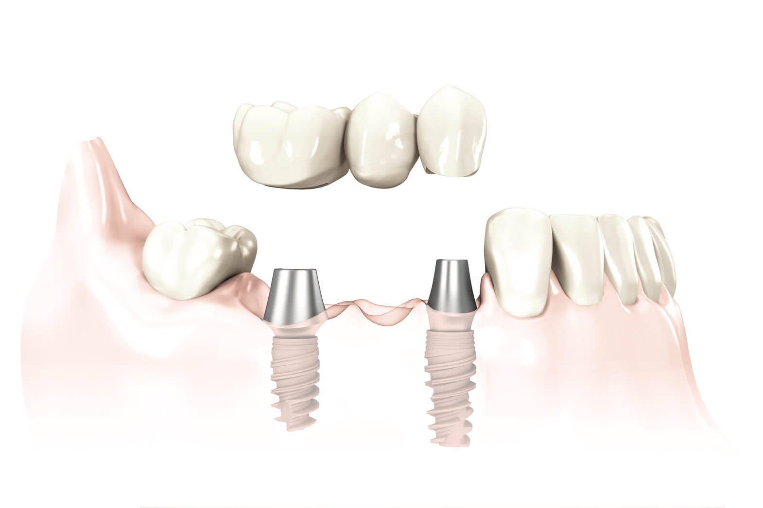 Keramikkronen für festsitzenden Zahnersatz auf Implantaten