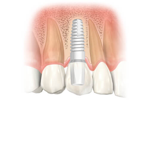Das Zahnimplantat im Oberkiefer nach der Befestigung aller Einzelteile