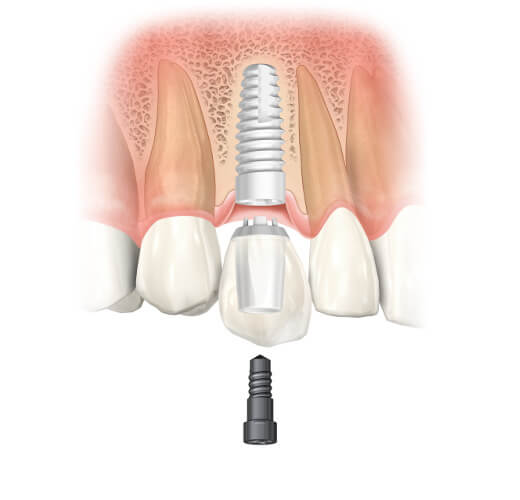 Die Einzelteile eines Zahnimplantats im Oberkiefer: Implantatschraube im Kieferknochen, Aufbau mit neuer Zahnkrone und Befestigungsschraube