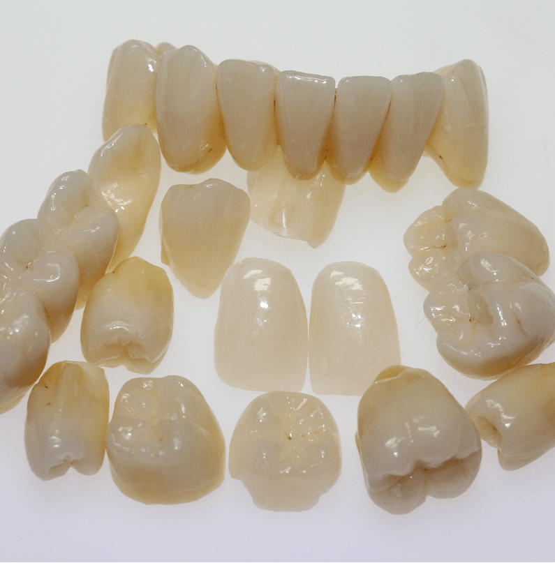 Veneers, Kronen und Teilkronen aus Keramik, schön und gut verträglich Veneers, Kronen und Teilkronen aus Keramik, schön und gut verträglich