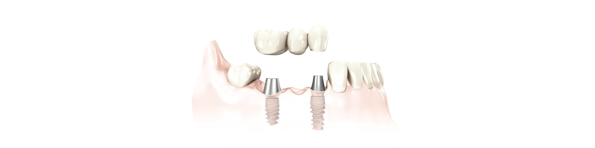 Implantatprothetik – Zahnersatz auf Implantaten