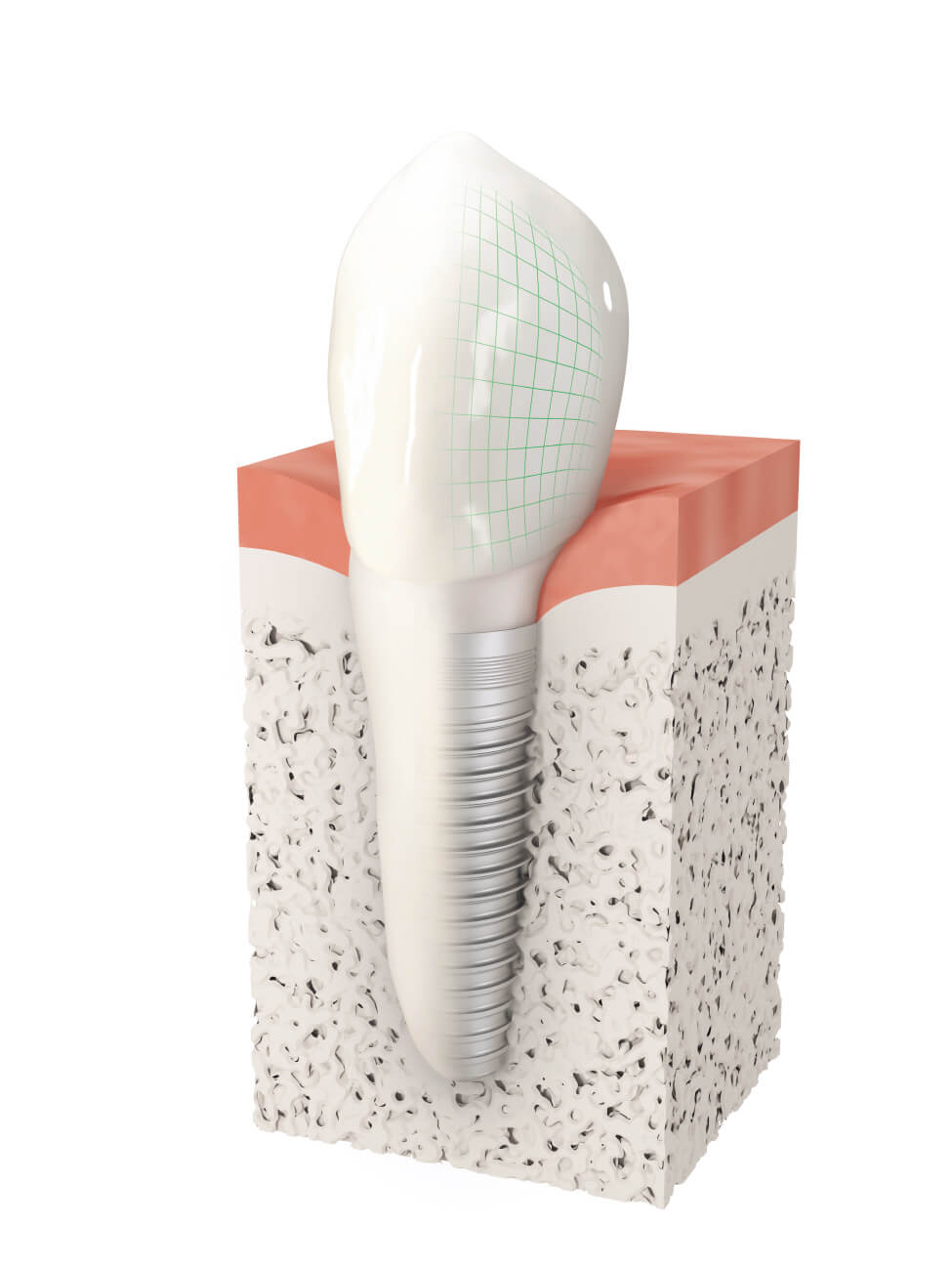 Zahnimplantat-Schraube im Kiefer mit fester Zahnkrone