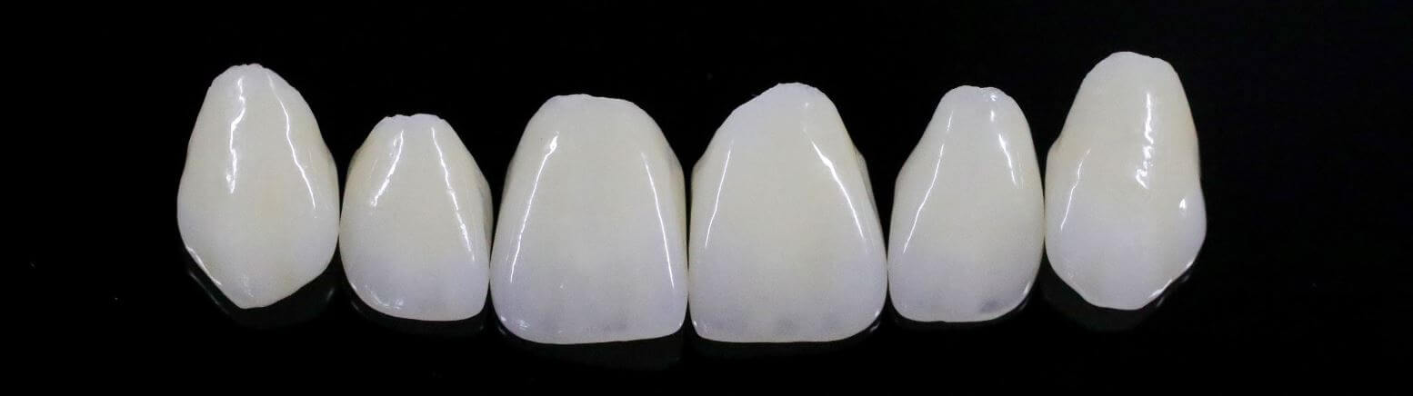 Veneers Verblendschale bei MunichDent