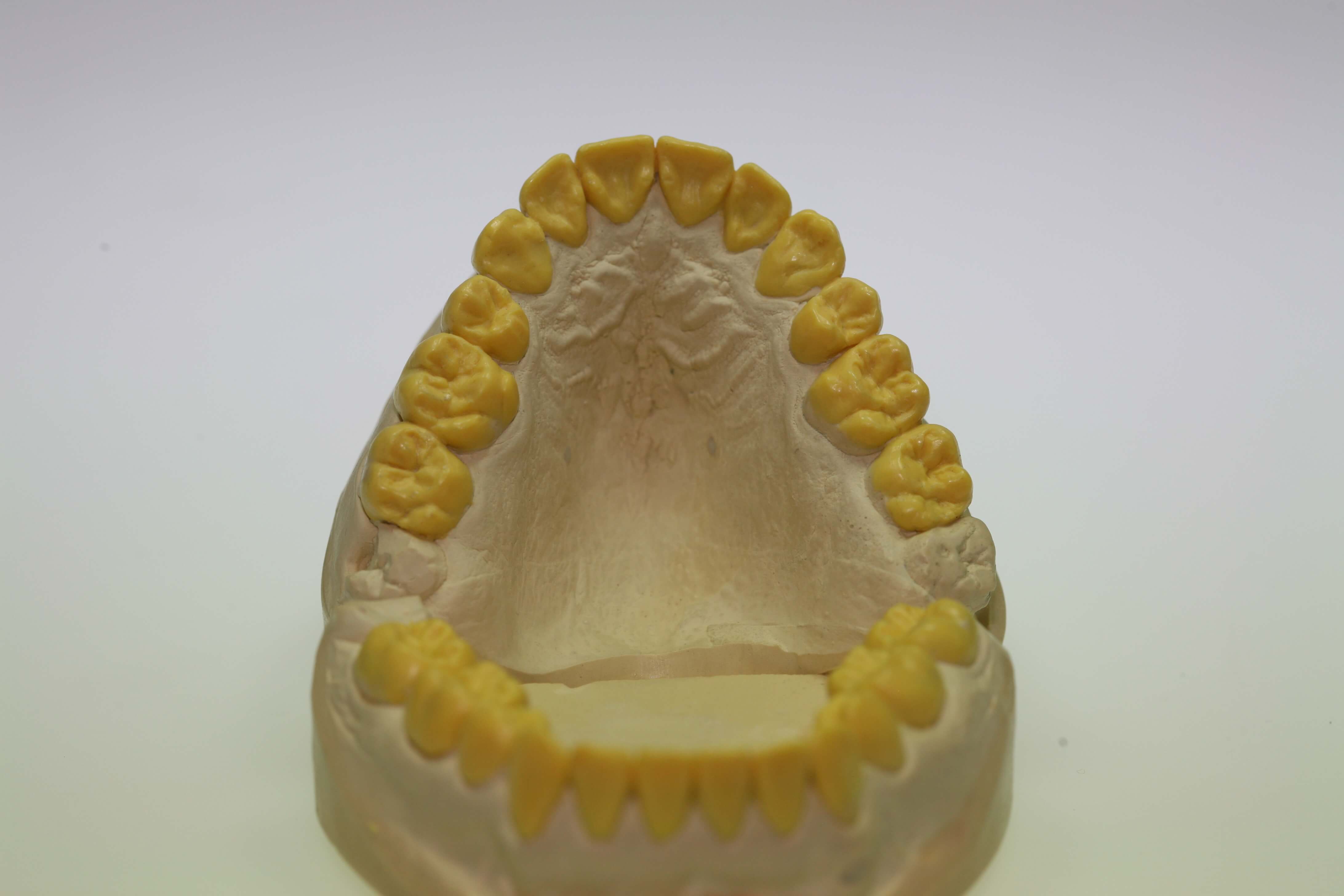 Herstellung von funktionellem Zahnersatz auf Basis eines Wachsmodells: Wax-up des Oberkiefers