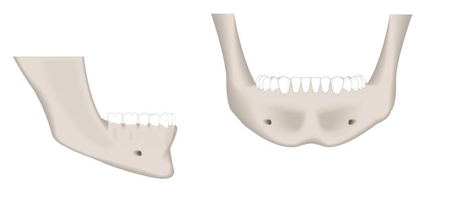 Gesunder Kieferknochen mit gutem Knochenangebot