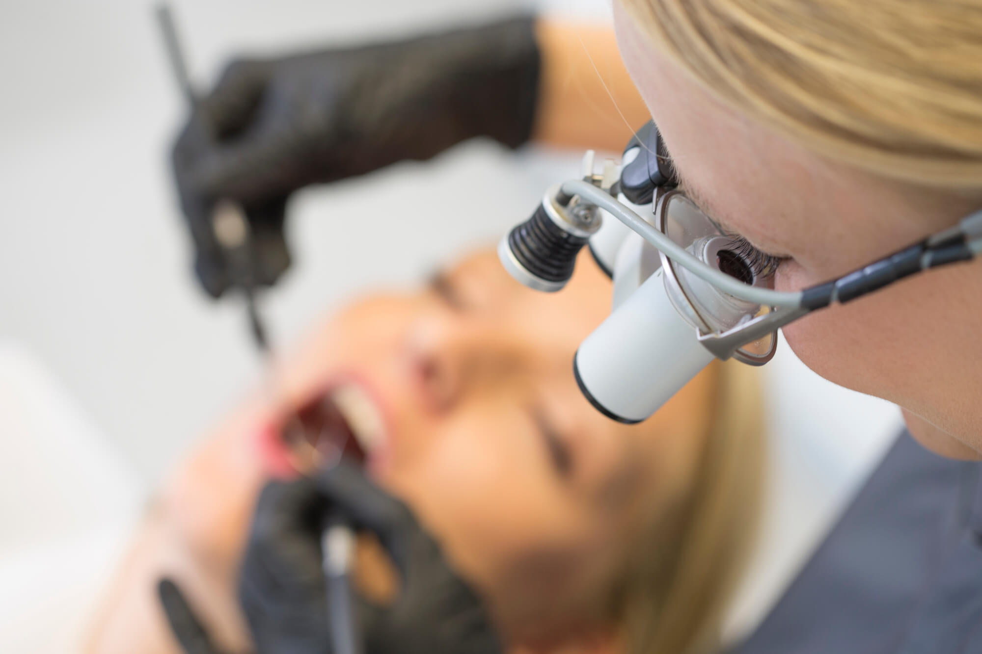 Zahnverfärbungen nach einer Wurzelbehandlung können durch ein inneres Bleaching korrigiert werden.