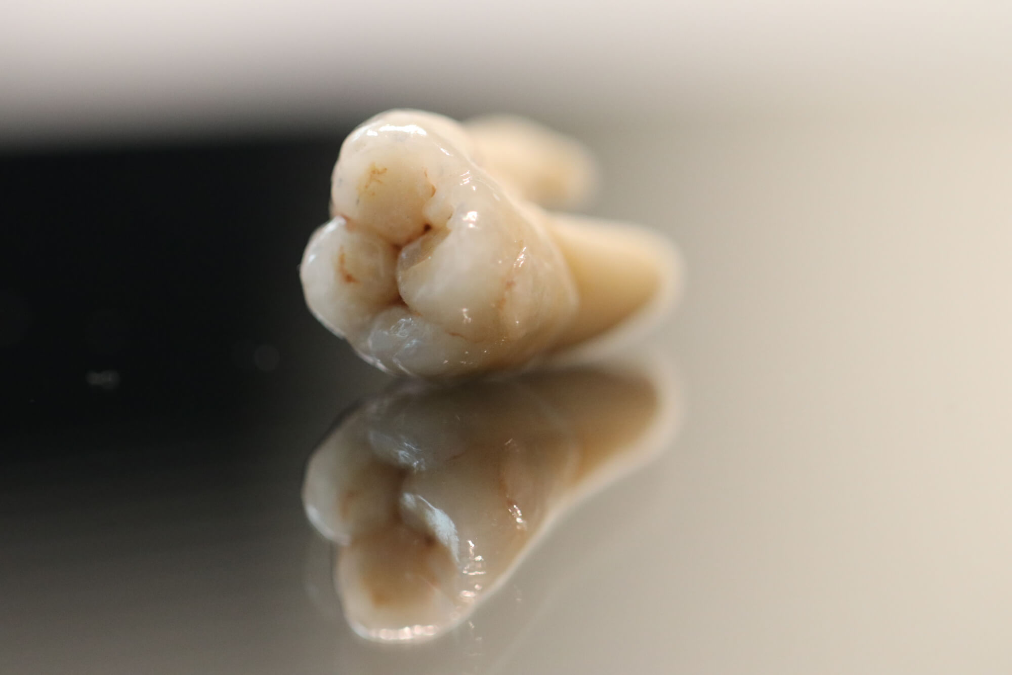 Lockere Zähne retten, sonst droht Zahnverlust