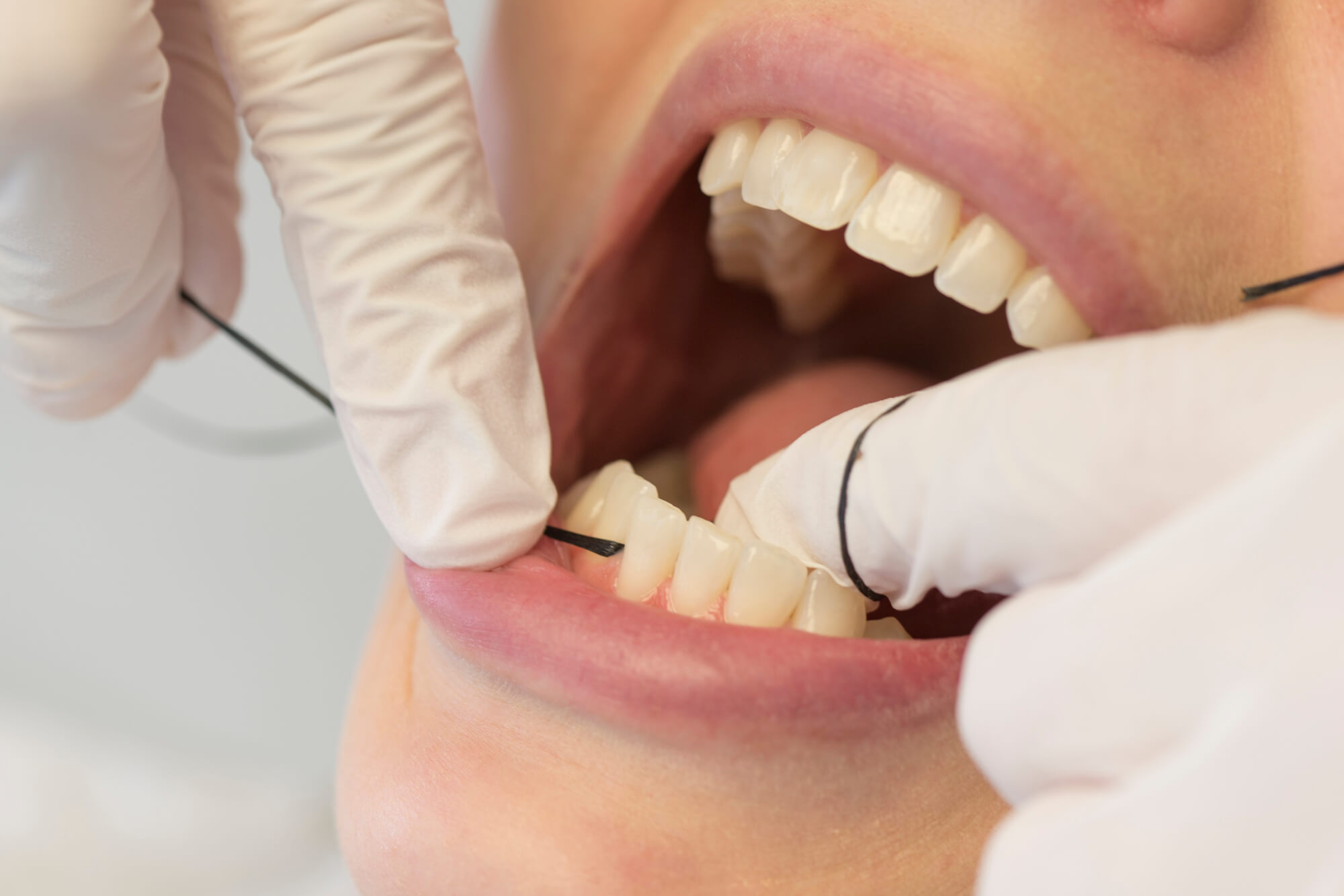 Zahnfleischbluten - ernstes Alarmsignal von Zahnfleischentzündung