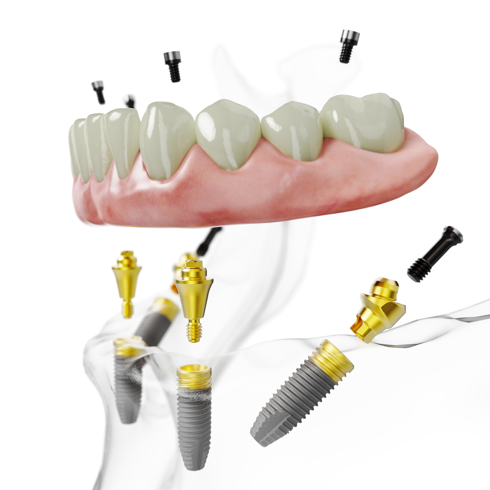 Das All-on-4® Behandlungskonzept: Suchen Sie eine Zahnersatzbehandlung auf 4 Implantaten die Ihr Leben verändert – ein neues Lächeln an einem Tag. 