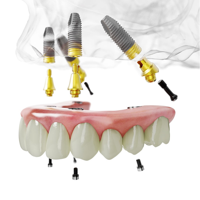 Das All-on-4® Behandlungskonzept in München für den Oberkiefer.